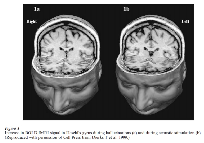 MRI In Psychiatry Research Paper