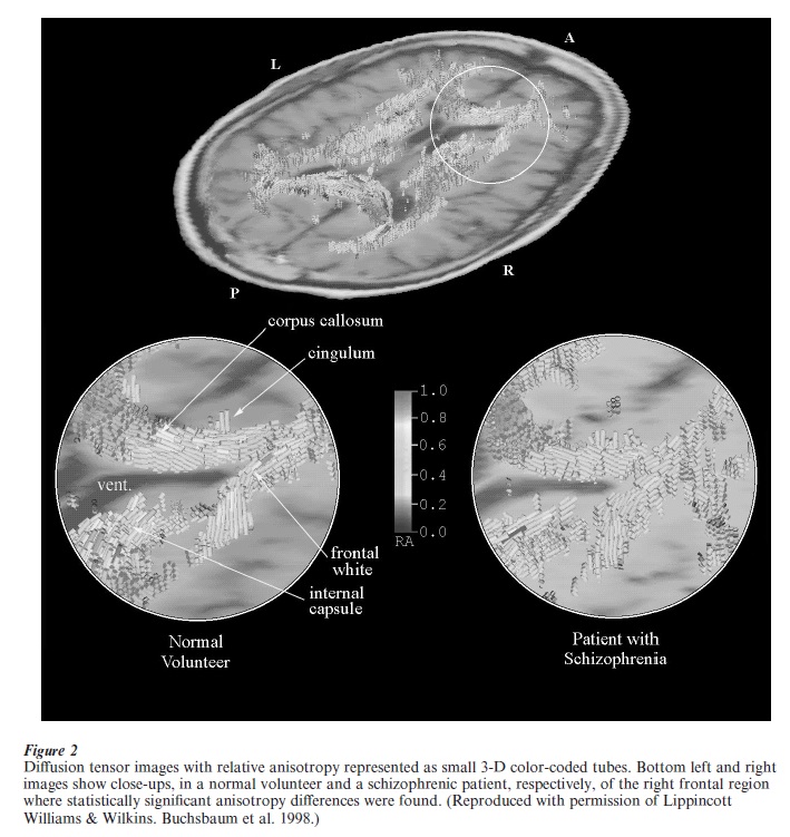 MRI In Psychiatry Research Paper